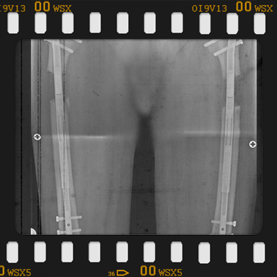 Radyografi görseli büyütmek için üzerine tıklayınız.